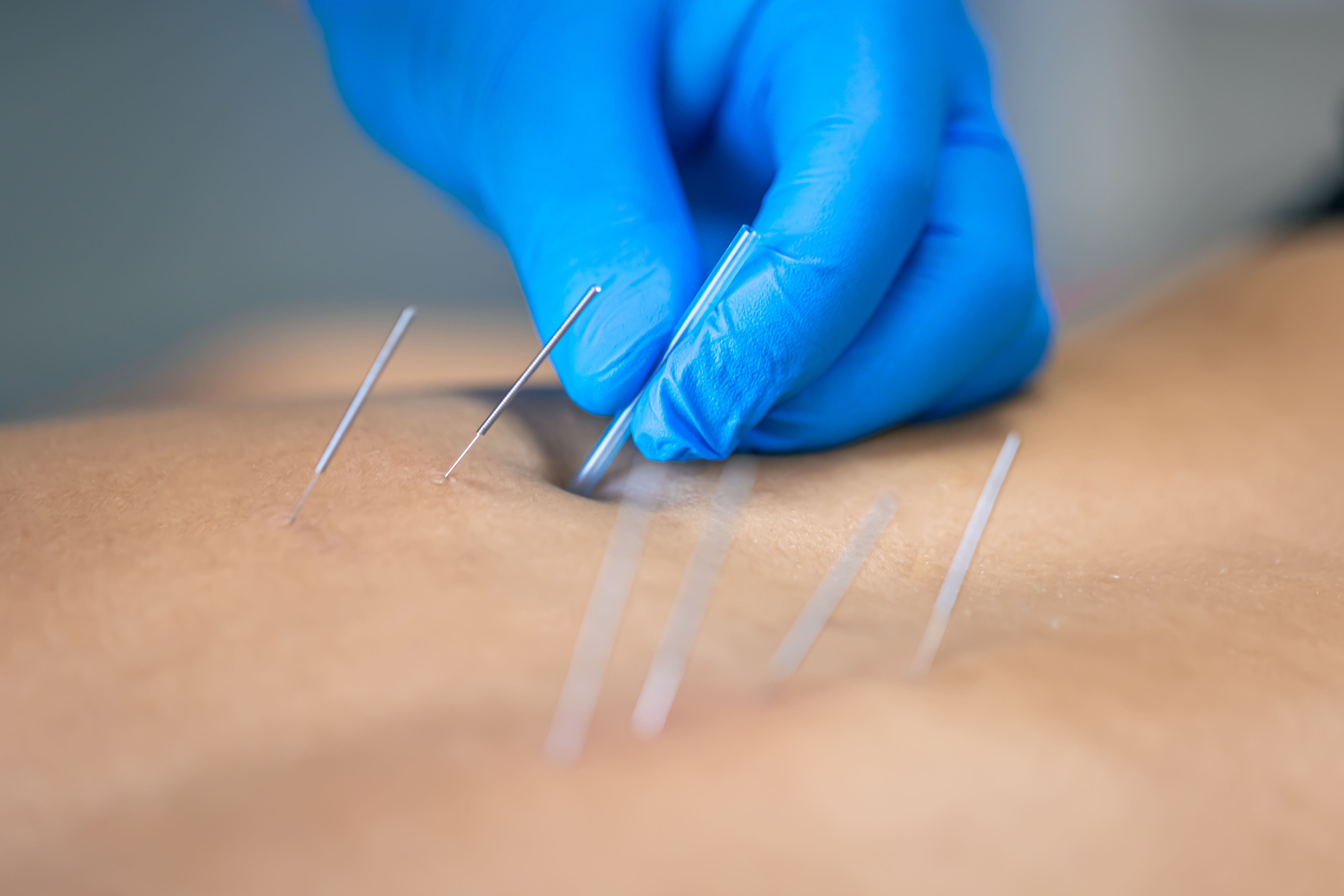 Needling Therapy